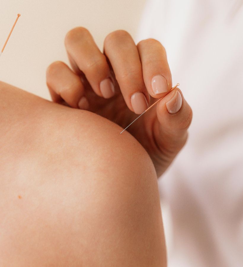 Acupuntura zonal